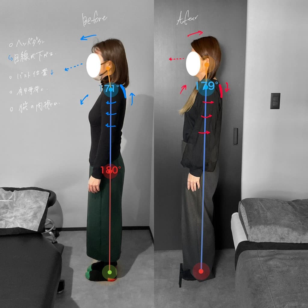 美姿勢矯正のビフォーアフター。ヘッドダウンと腕の内捻れが改善した例