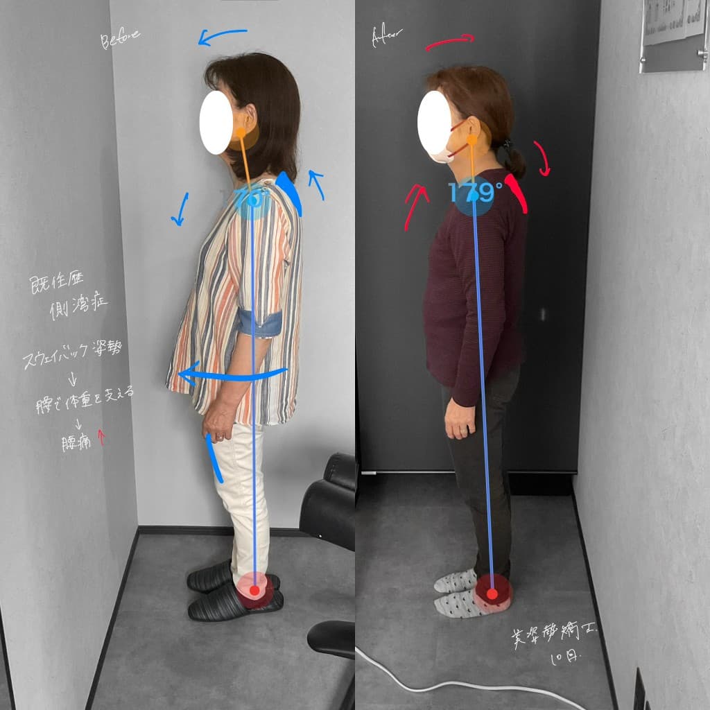 スウェイバック姿勢から直立に近づいたビフォーアフター