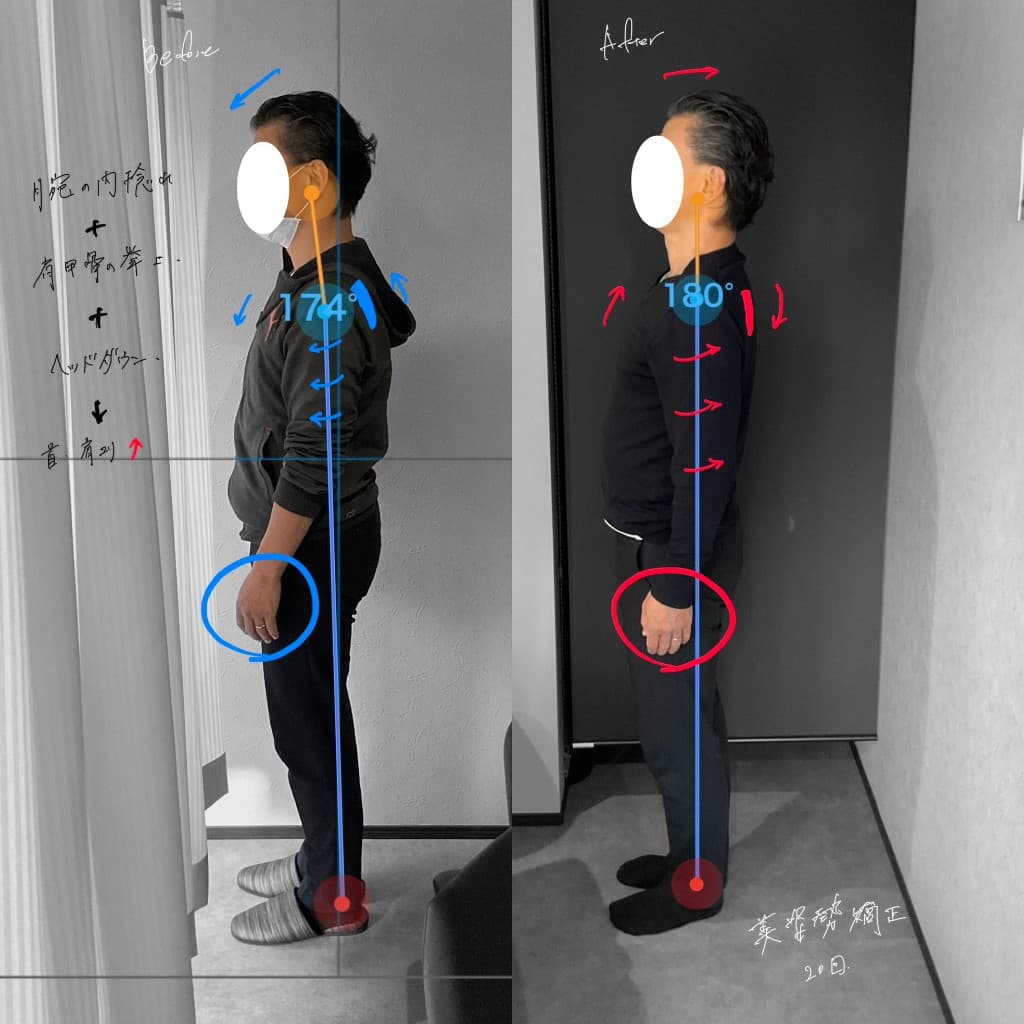 腕の内捻れと首肩こりに伴う姿勢が改善した例
